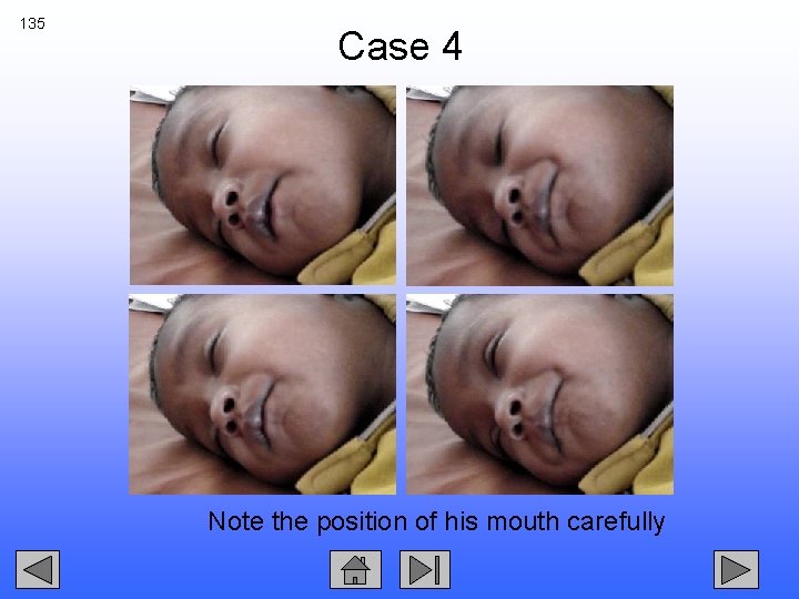 135 Case 4 Note the position of his mouth carefully 