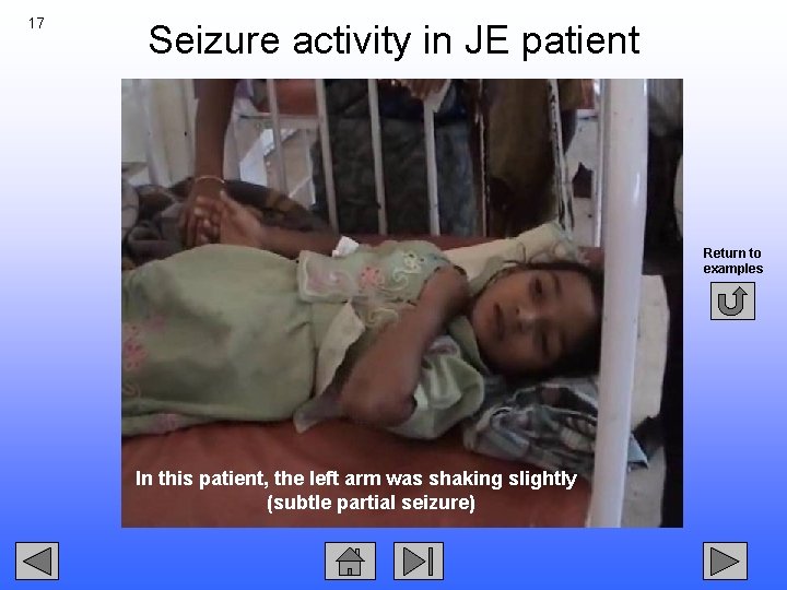 17 Seizure activity in JE patient Return to examples In this patient, the left