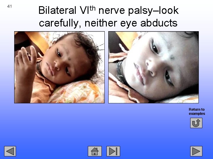 41 Bilateral VIth nerve palsy–look carefully, neither eye abducts Return to examples 