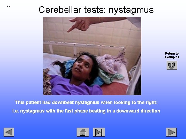 62 Cerebellar tests: nystagmus Return to examples This patient had downbeat nystagmus when looking