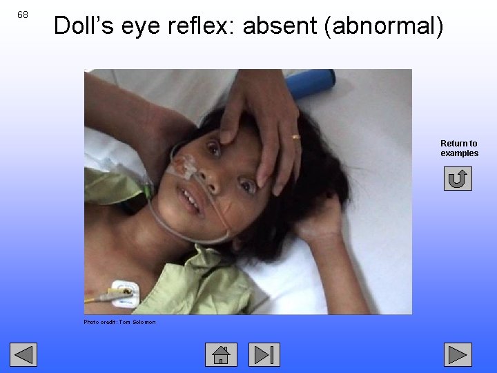 68 Doll’s eye reflex: absent (abnormal) Return to examples Photo credit: Tom Solomon 