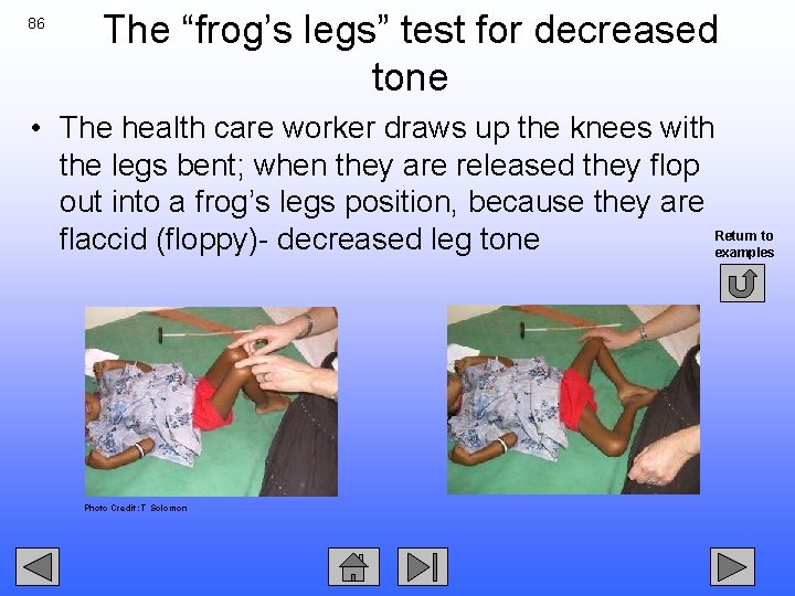 86 The “frog’s legs” test for decreased tone • The health care worker draws