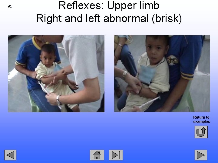 93 Reflexes: Upper limb Right and left abnormal (brisk) Return to examples 
