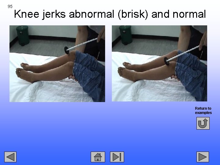 95 Knee jerks abnormal (brisk) and normal Return to examples 