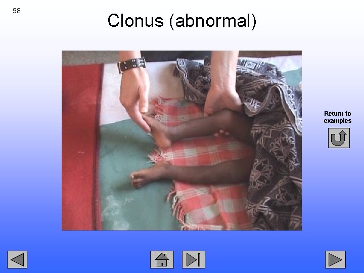 98 Clonus (abnormal) Return to examples 