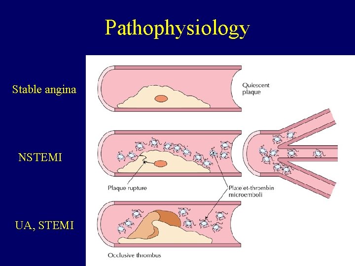 Pathophysiology Stable angina NSTEMI UA, STEMI 