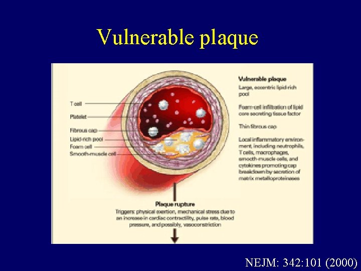 Vulnerable plaque NEJM: 342: 101 (2000) 