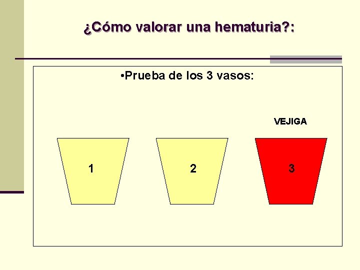 ¿Cómo valorar una hematuria? : • Prueba de los 3 vasos: VEJIGA 1 2 ¿Cómo valorar una hematuria? : • Prueba de los 3 vasos: VEJIGA 1 2