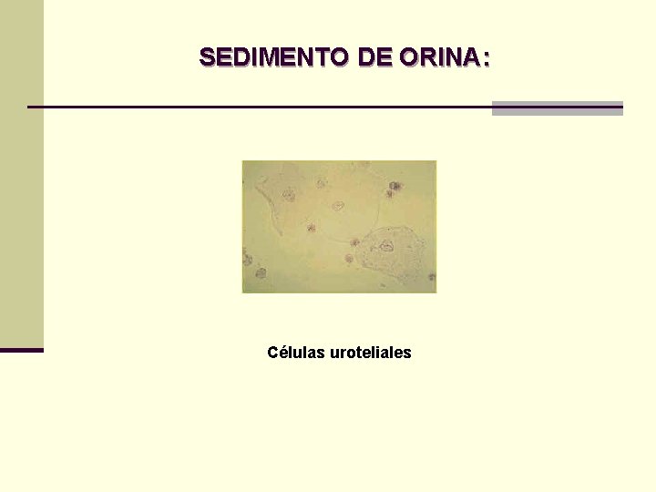 SEDIMENTO DE ORINA: Células uroteliales SEDIMENTO DE ORINA: Células uroteliales