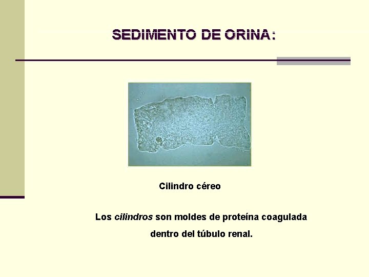 SEDIMENTO DE ORINA: Cilindro céreo Los cilindros son moldes de proteína coagulada dentro del SEDIMENTO DE ORINA: Cilindro céreo Los cilindros son moldes de proteína coagulada dentro del