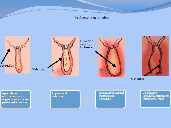 Pictorial Explanation mucus Distention causing Ischemia obstruction Distention Gangrene Appendiceal obstruction/early appendicitis – visceral