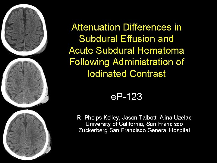 Attenuation Differences in Subdural Effusion and Acute Subdural Hematoma Following Administration of Iodinated Contrast