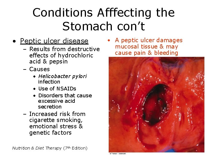 Conditions Afffecting the Stomach con’t • Peptic ulcer disease – Results from destructive effects Conditions Afffecting the Stomach con’t • Peptic ulcer disease – Results from destructive effects