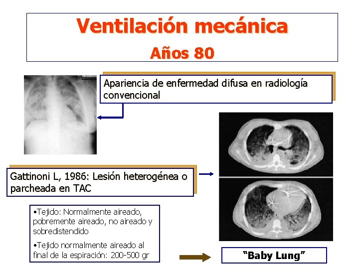 Ventilación mecánica Años 80 Apariencia de enfermedad difusa en radiología convencional Gattinoni L, 1986: