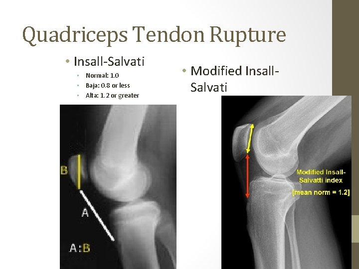 Quadriceps Tendon Rupture • Insall-Salvati • Normal: 1. 0 • Baja: 0. 8 or