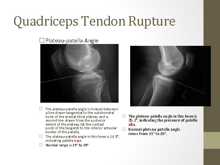 Quadriceps Tendon Rupture � Plateau-patella Angle � The plateau-patella angle is formed between a