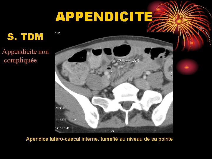 APPENDICITE S. TDM Appendicite non compliquée Apendice latéro-caecal interne, tuméfié au niveau de sa