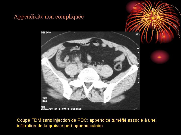 Appendicite non compliquée Coupe TDM sans injection de PDC: appendice tuméfié associé à une