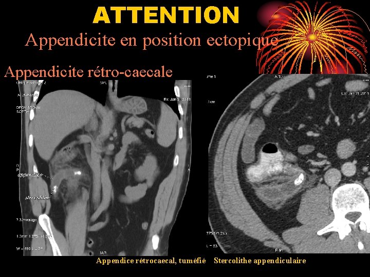 ATTENTION Appendicite en position ectopique Appendicite rétro-caecale Appendice rétrocaecal, tuméfié Stercolithe appendiculaire 