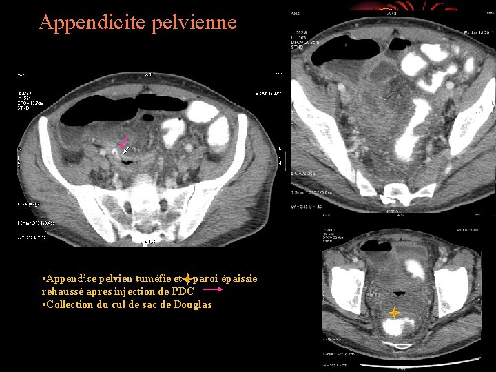 Appendicite pelvienne • Appendice pelvien tuméfié et à paroi épaissie rehaussé après injection de