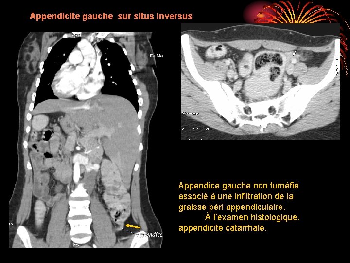 Appendicite gauche sur situs inversus Appendice gauche non tuméfié associé à une infiltration de
