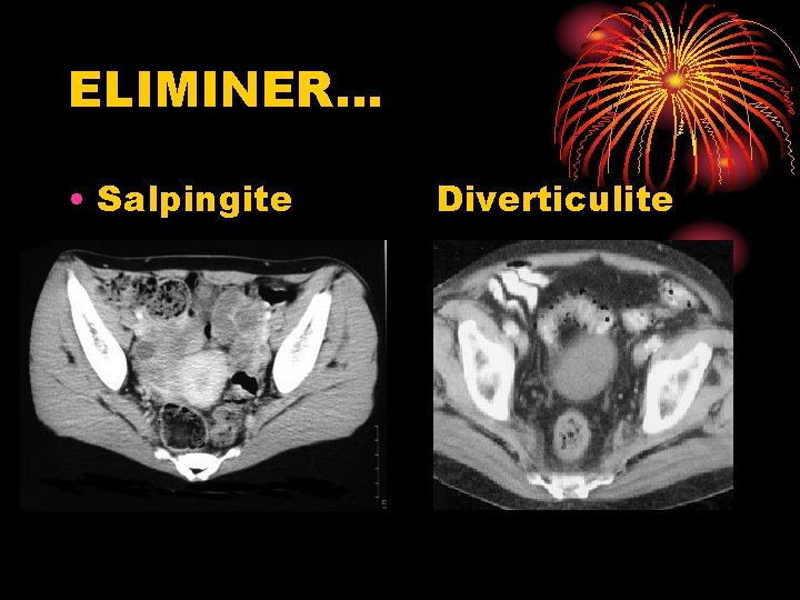 ELIMINER… • Salpingite Diverticulite 