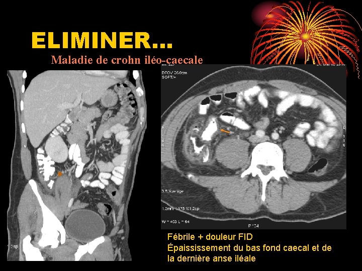 ELIMINER… Maladie de crohn iléo-caecale Fébrile + douleur FID Épaississement du bas fond caecal