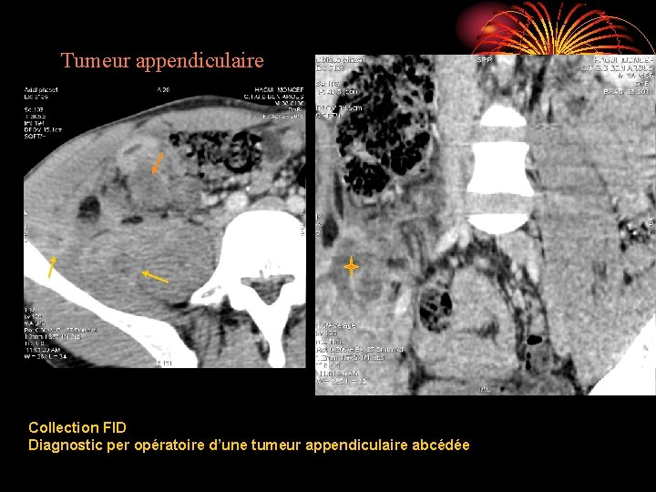 Tumeur appendiculaire Collection FID Diagnostic per opératoire d’une tumeur appendiculaire abcédée 