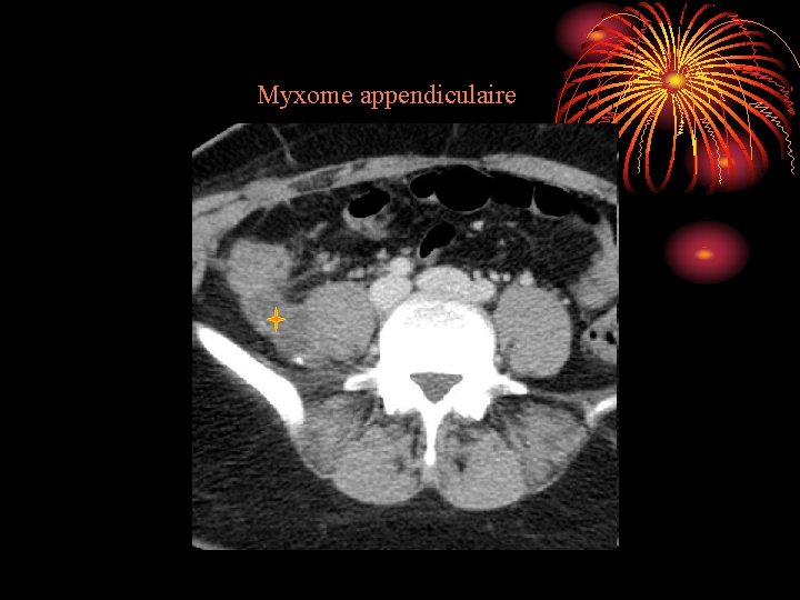 Myxome appendiculaire 