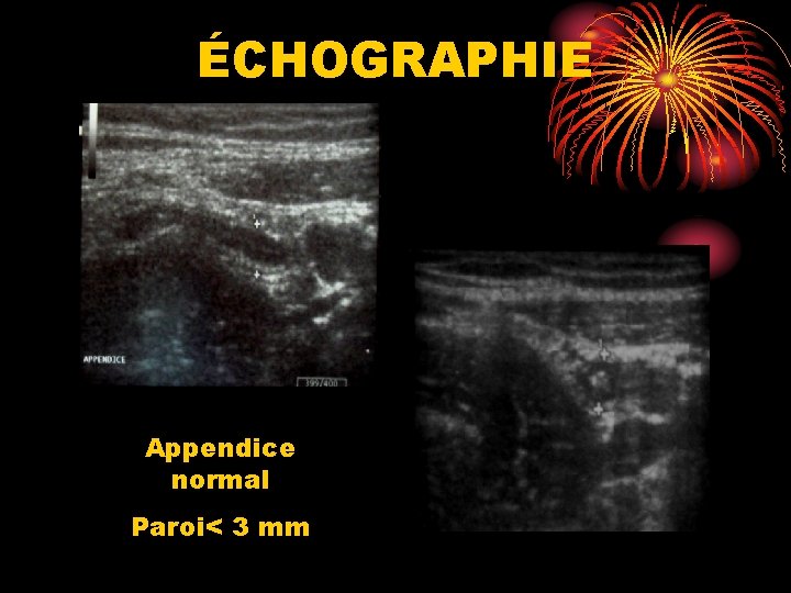 ÉCHOGRAPHIE Appendice normal Paroi< 3 mm 