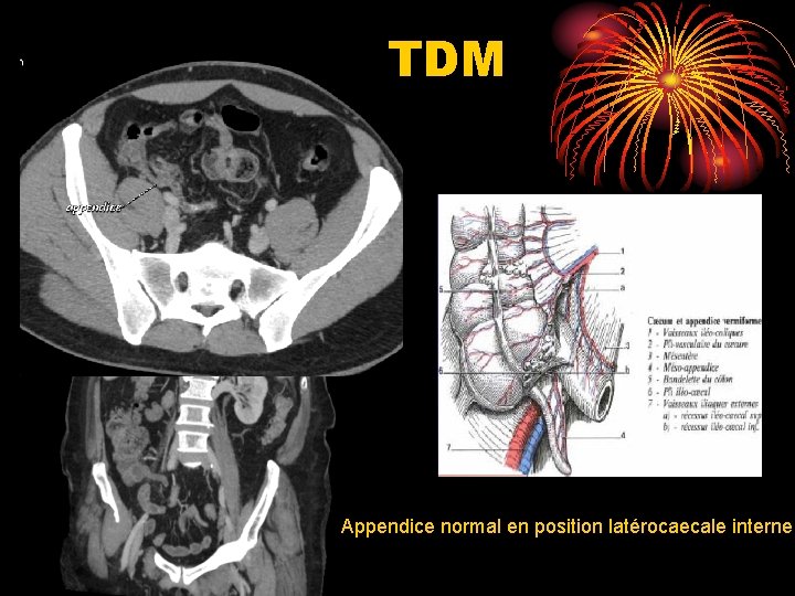 TDM Appendice normal en position latérocaecale interne 