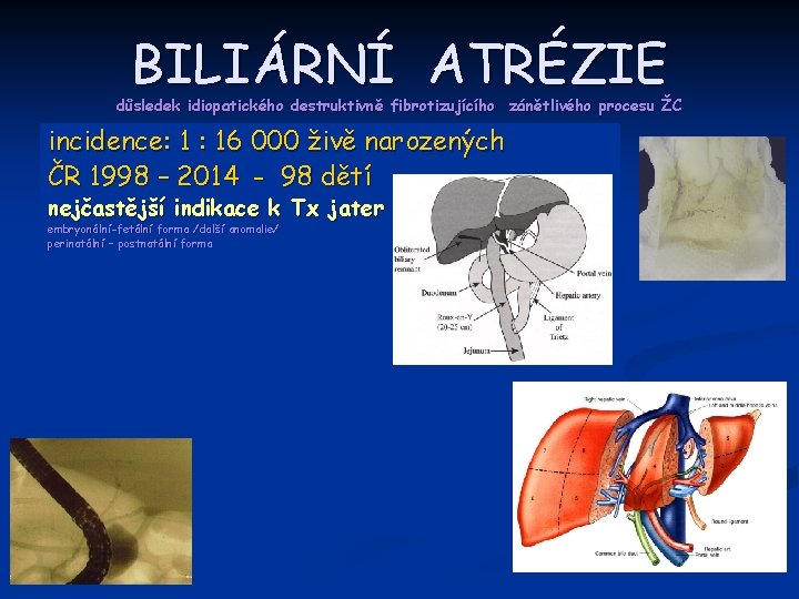 BILIÁRNÍ ATRÉZIE důsledek idiopatického destruktivně fibrotizujícího zánětlivého procesu ŽC incidence: 1 : 16 000