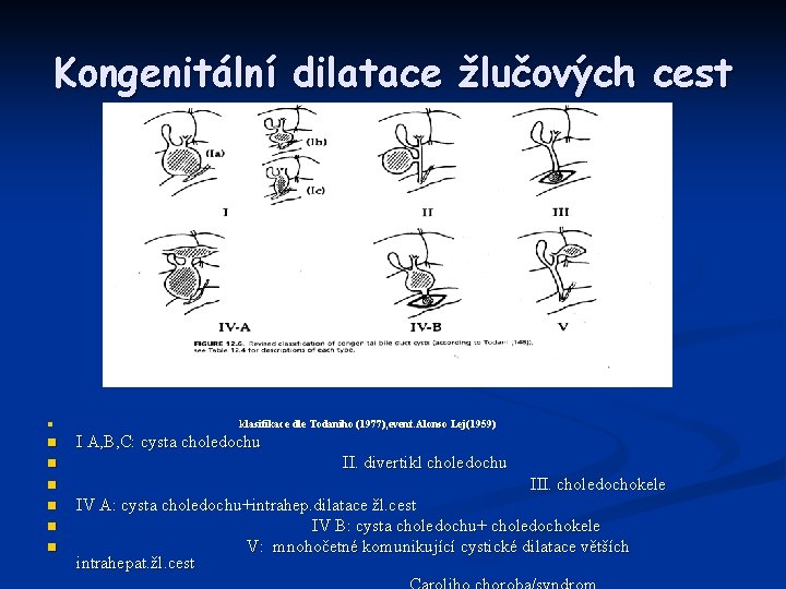 Kongenitální dilatace žlučových cest n n n n klasifikace dle Todaniho (1977), event. .