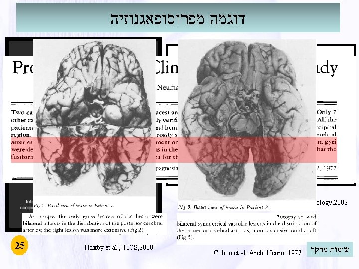 דוגמה מפרוסופאגנוזיה Barton et al. , Neurology, 2002 25 Haxby et al. , דוגמה מפרוסופאגנוזיה Barton et al. , Neurology, 2002 25 Haxby et al. ,