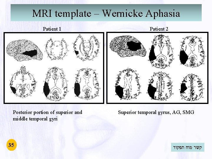 MRI template – Wernicke Aphasia Patient 1 Posterior portion of superior and middle temporal MRI template – Wernicke Aphasia Patient 1 Posterior portion of superior and middle temporal