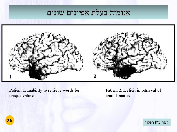 אנומיה בעלת אפיונים שונים Patient 1: Inability to retrieve words for unique entities אנומיה בעלת אפיונים שונים Patient 1: Inability to retrieve words for unique entities