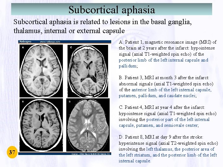 Subcortical aphasia is related to lesions in the basal ganglia, thalamus, internal or external Subcortical aphasia is related to lesions in the basal ganglia, thalamus, internal or external
