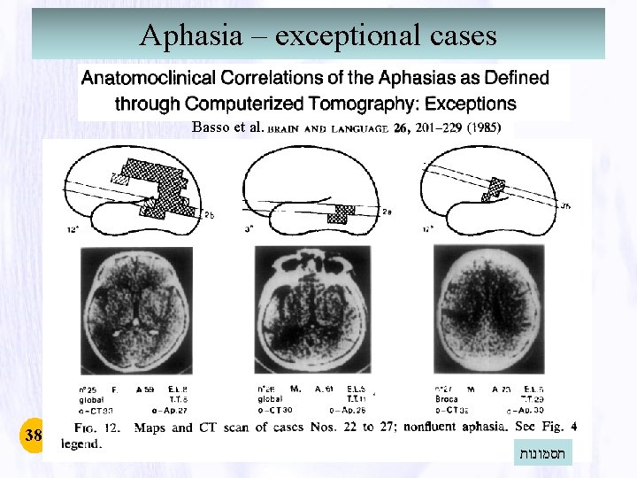 Aphasia – exceptional cases Basso et al. 38 תסמונות Aphasia – exceptional cases Basso et al. 38 תסמונות