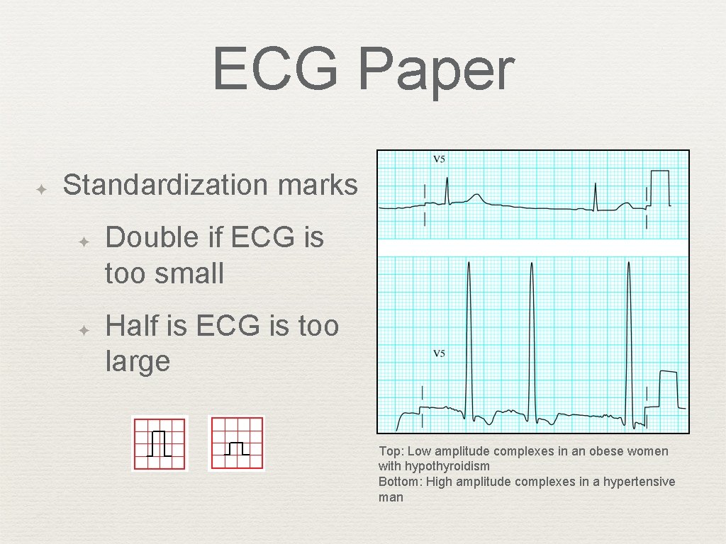 ECG Paper ✦ Standardization marks ✦ ✦ Double if ECG is too small Half