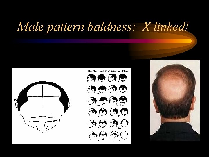 Male pattern baldness: X linked! 