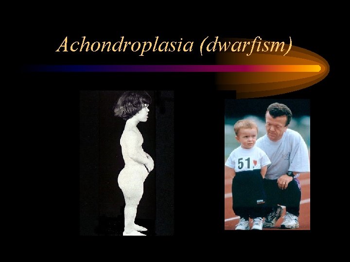 Achondroplasia (dwarfism) 