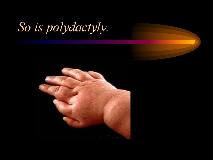 So is polydactyly. 