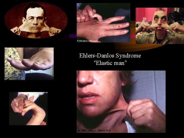  Ehlers-Danlos Syndrome “Elastic man” <> 