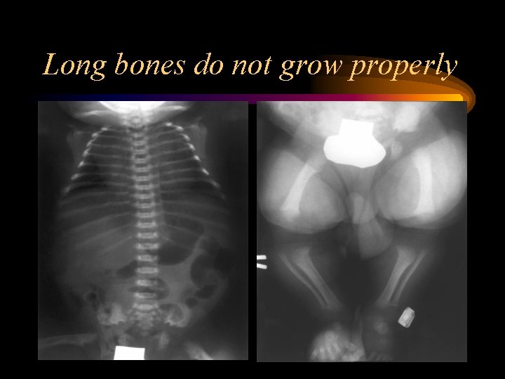 Long bones do not grow properly 