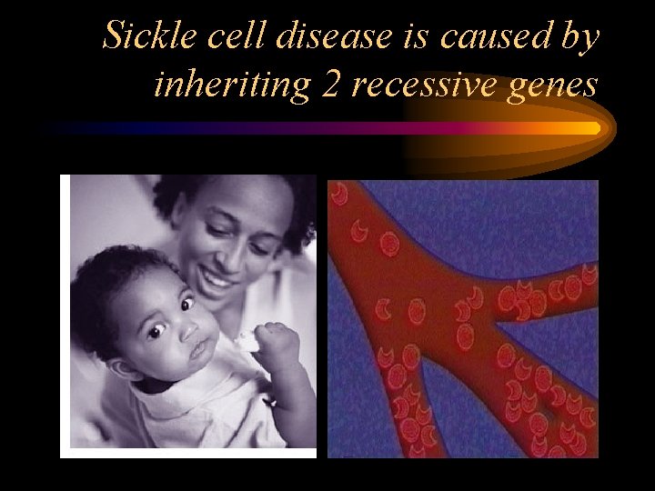 Sickle cell disease is caused by inheriting 2 recessive genes 