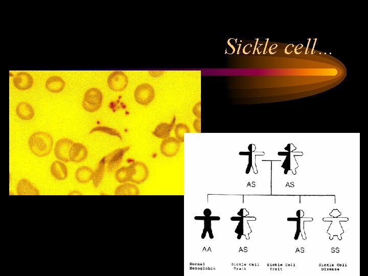 Sickle cell… 