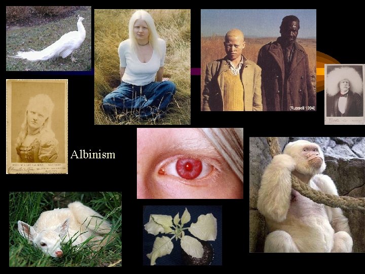 Albinism 