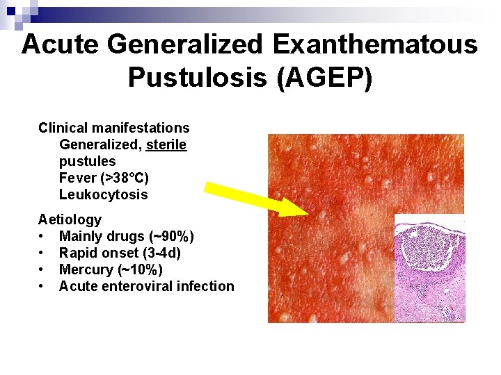 Acute Generalized Exanthematous Pustulosis (AGEP) Clinical manifestations • Generalized, sterile pustules • Fever (>38°C)