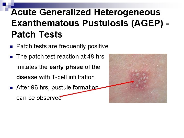 Acute Generalized Heterogeneous Exanthematous Pustulosis (AGEP) Patch Tests n Patch tests are frequently positive