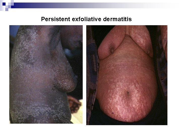 Persistent exfoliative dermatitis 